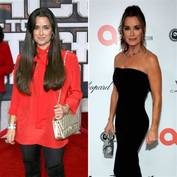 
Kyle Richards Weight Loss Journey- Before And After Photo 
